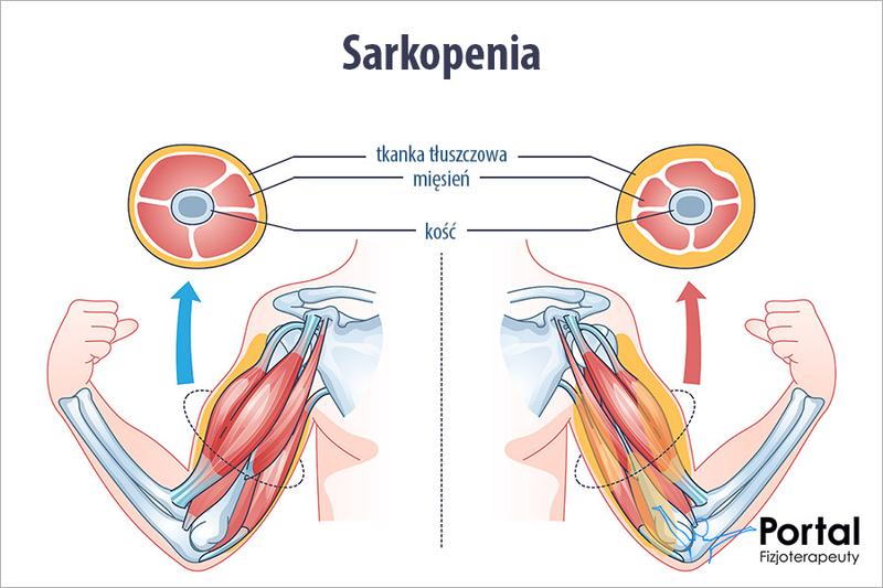 Zapobieganie sarkopenii