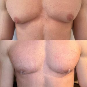 Skuteczne metody na ginekomastię – jak szybko pozbyć się gino?