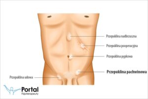 Czym jest przepuklina i jak ją rozpoznać?
